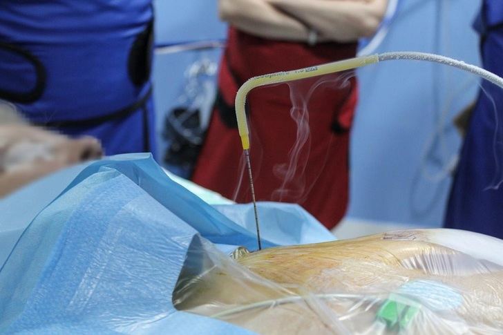 Nueva técnica en el Hospital de Toledo para el tratamiento poco invasivo de los nódulos tumorales de pulmón