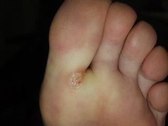Aumentan los casos de papiloma plantar en Castilla-La Mancha durante el verano