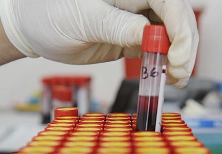 Castilla-La Mancha registra el pasado año 87 nuevos diagnósticos de VIH y veinte de Sida